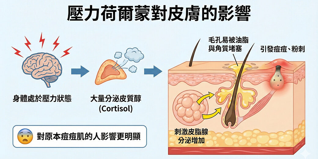 肌膚也有「壓力症候群」？壓力過大 恐導致肌膚走下坡！、情緒EMO傷肝、傷皮膚？！5招教你蛻變自信，改善膚質喔、肌膚也有「壓力症候群」？壓力過大 恐導致肌膚走下坡！、過大的生活壓力，會造成肌膚老化？、濕疹與情緒病的相互影響